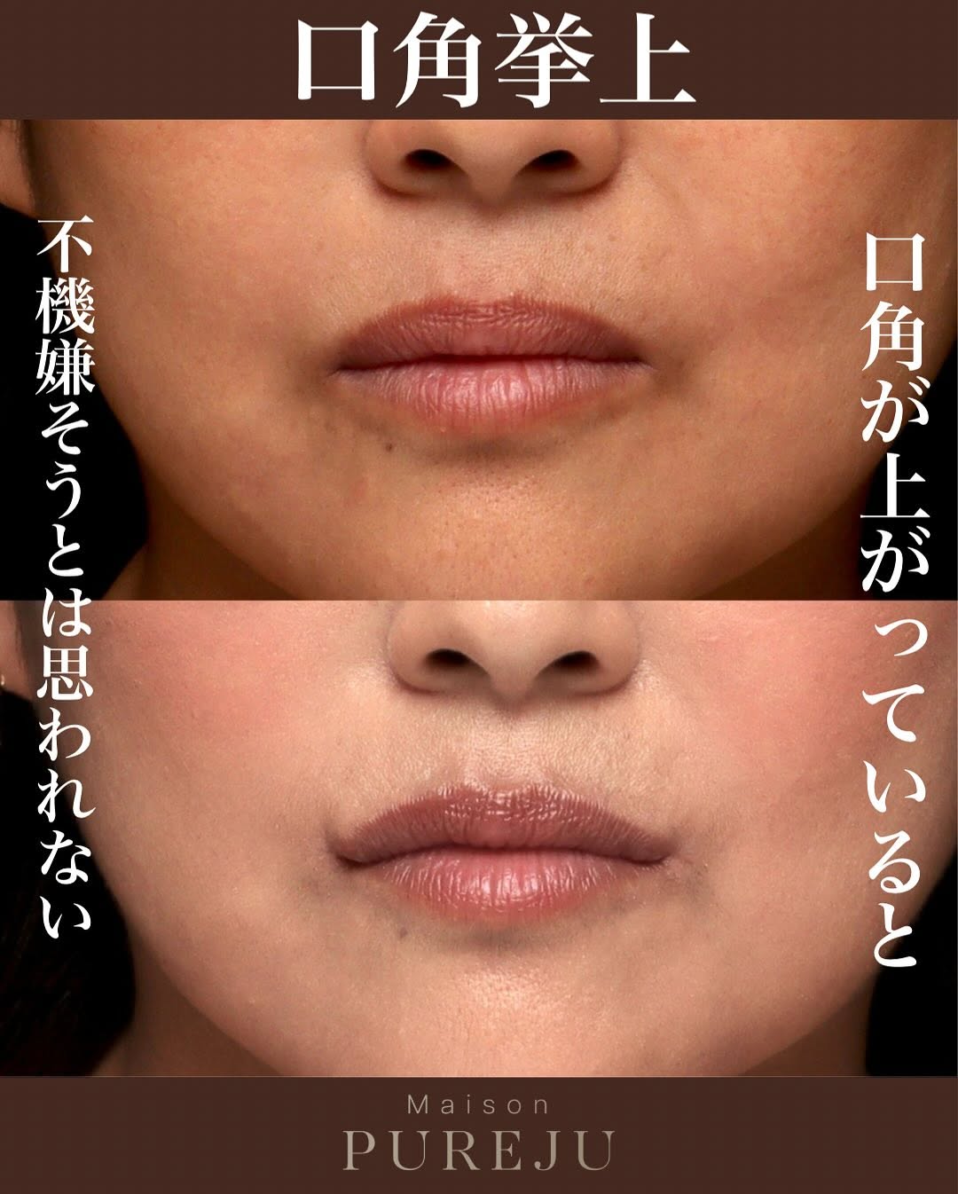 口角挙上で不機嫌そうに思われる悩みを解決した症例 画像3