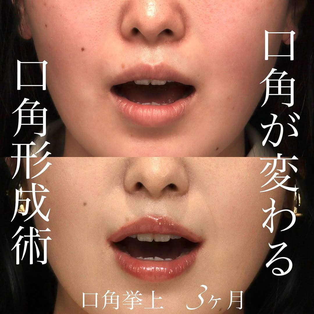 口角挙上で真顔でも口角が上がり印象が良くなった症例 画像2