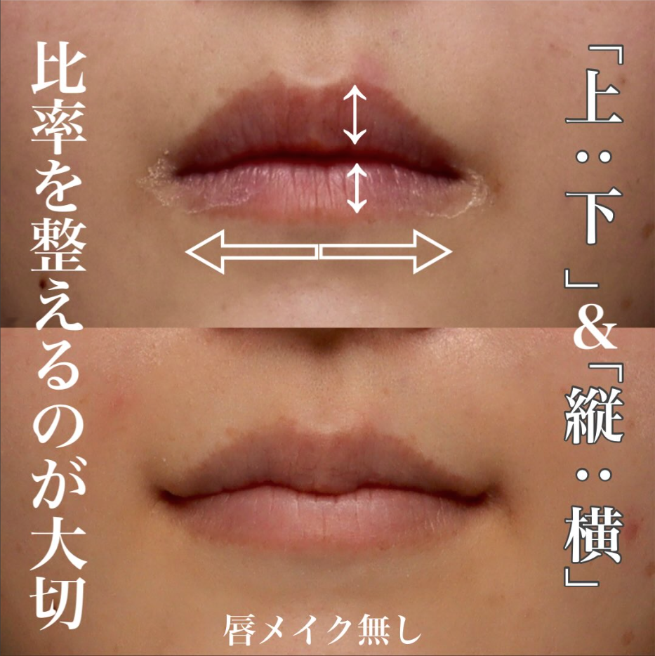 M字リップ＋口角挙上で唇の黄金比を整え小顔効果も出した症例（術後5ヶ月・メイクなし） 画像2
