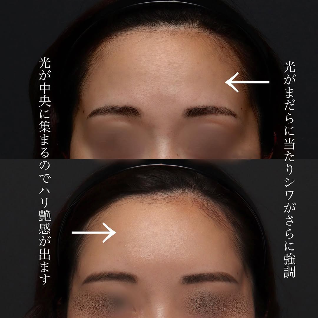 額・こめかみへのヒアルロン酸注射で顔に丸みと女性らしい柔らかい印象を出した症例 画像2