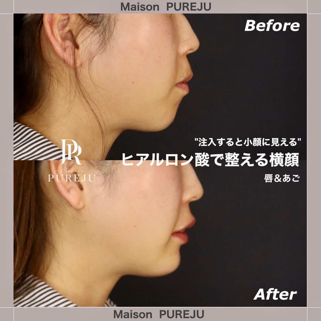 ヒアルロン酸注入で整える横顔｜あご+唇で小顔効果とEライン改善