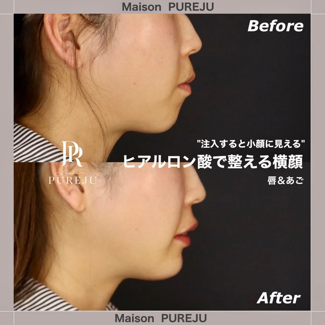 ヒアルロン酸注入で整える横顔|あご+唇で小顔効果とEライン改善