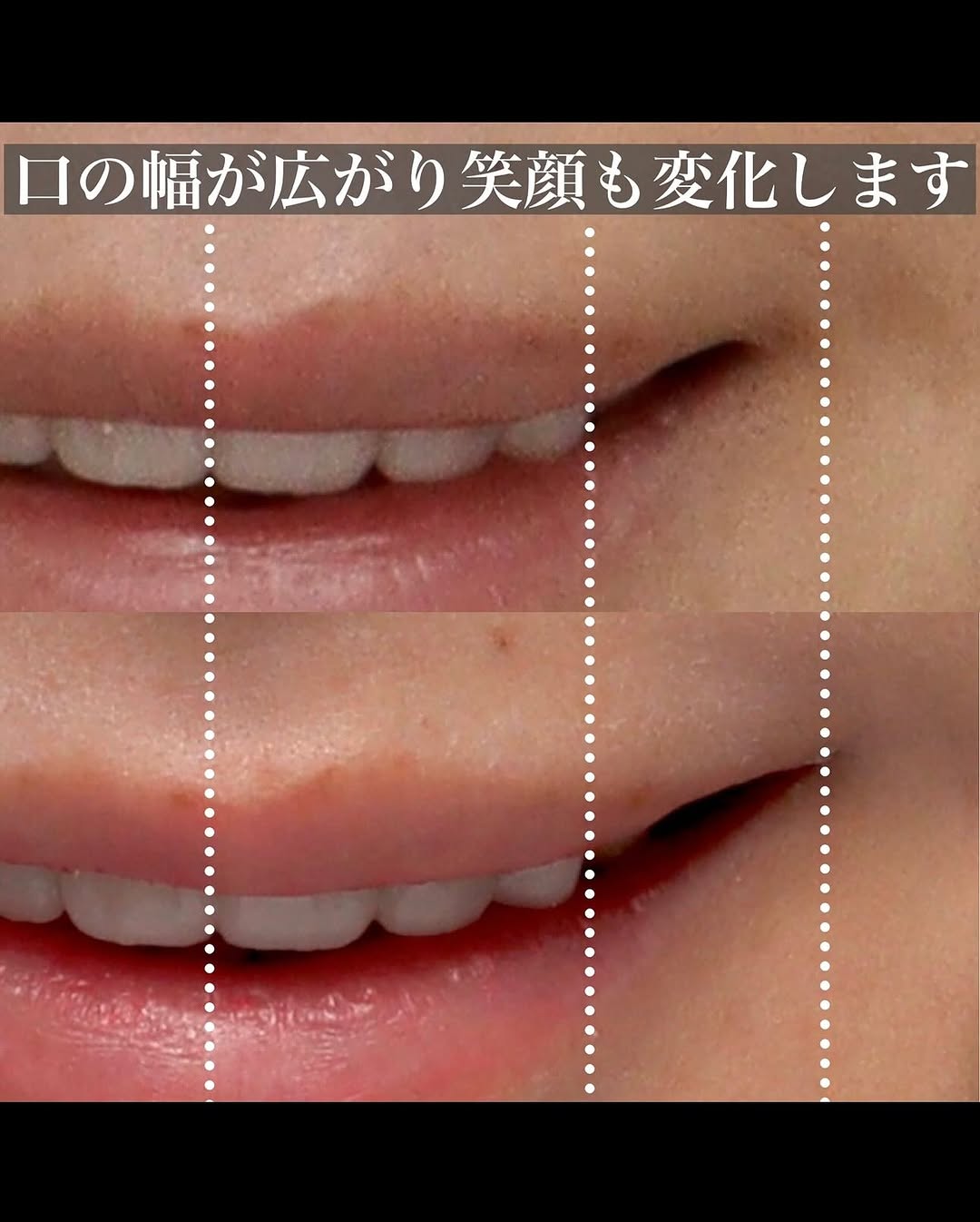 口角挙上で笑顔が変わり笑いやすさとお顔の余白改善を実現した症例 画像2