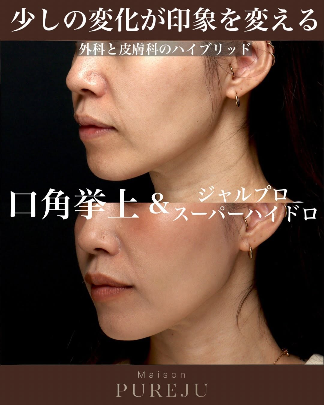 口角挙上＋ジャルプロスーパーハイドロで口元の若返りを実現した症例 画像3