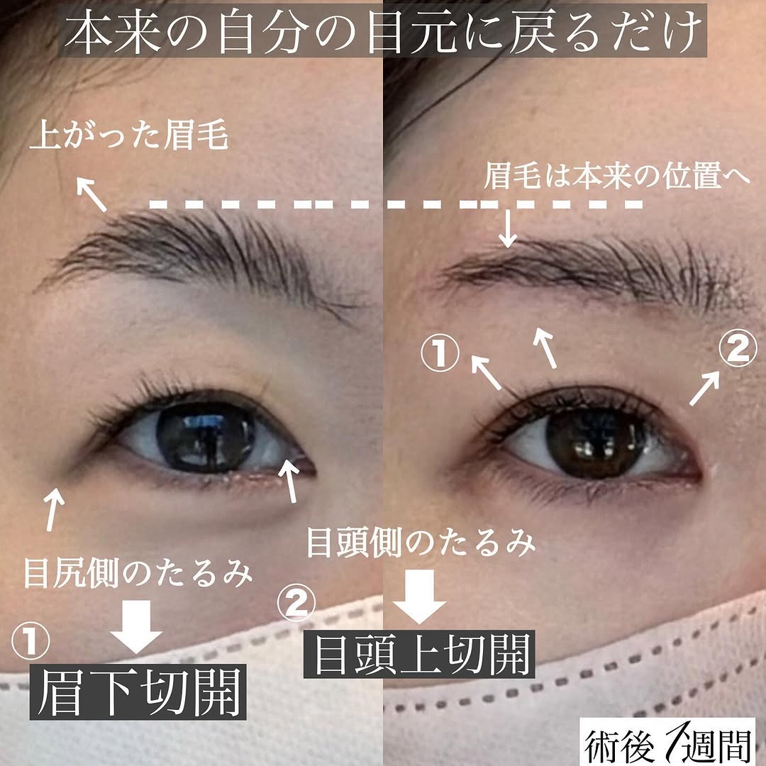 眉下切開＋目頭上切開でまぶたを全体的にすっきりさせた症例（術後1週間） 画像2