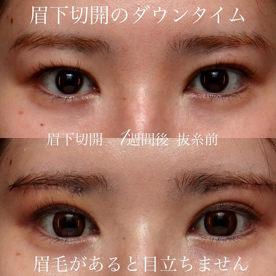 眉下切開術後1週間（抜糸前）のダウンタイムの経過