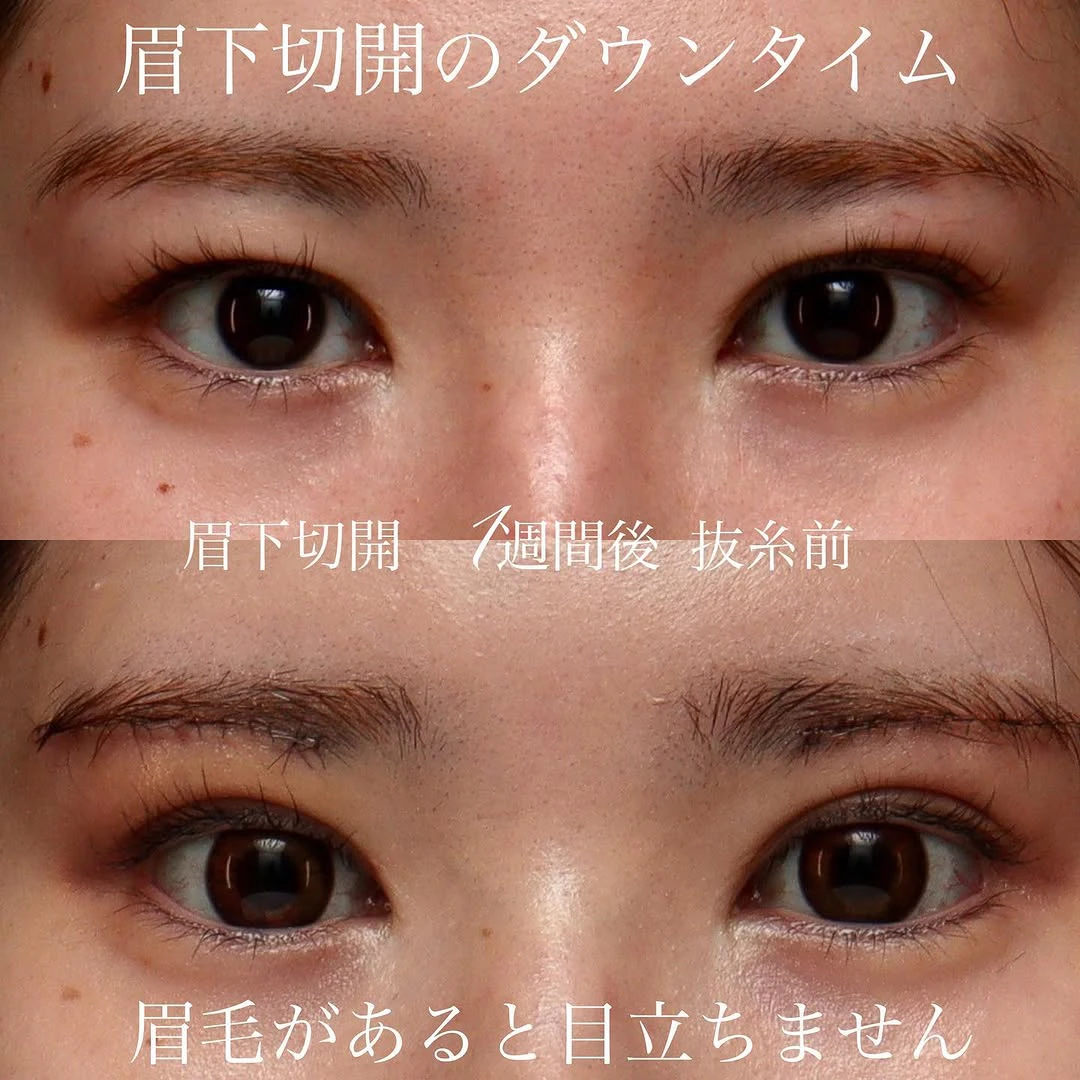 眉下切開術後1週間(抜糸前)のダウンタイムの経過
