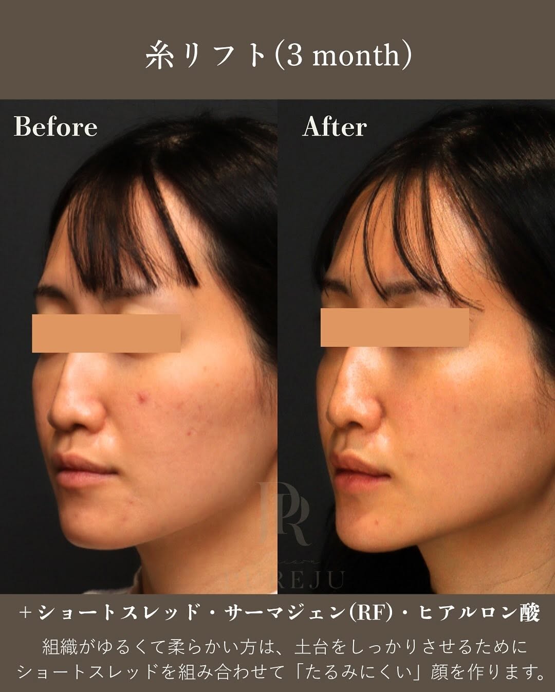 糸リフト×複合治療｜ヒアルロン酸・RF・ショートスレッド・脂肪溶解を組み合わせた輪郭美の作り方 画像4