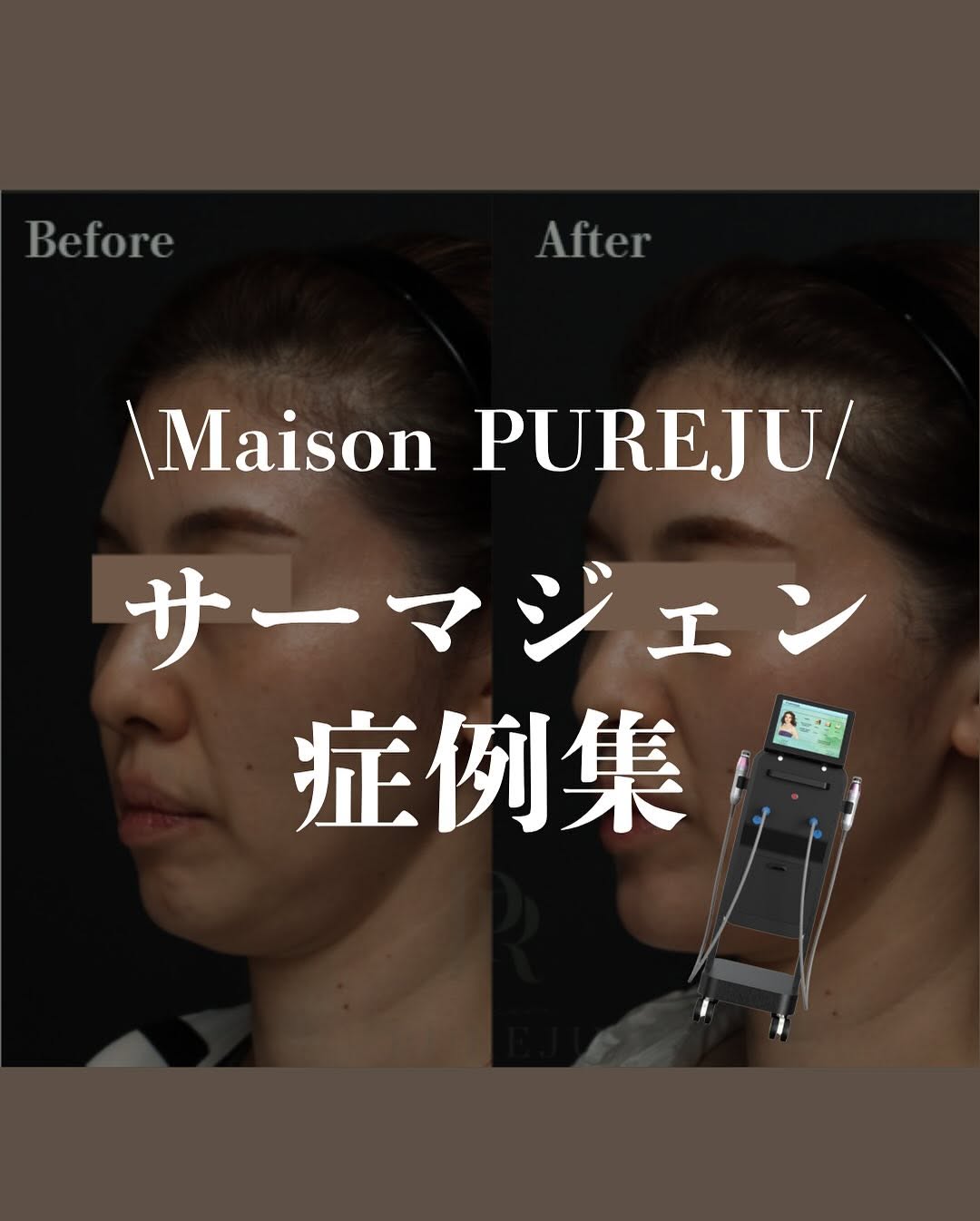 サーマジェン症例｜高周波たるみ治療の2段階効果と当院こだわりのオーダーメイド照射