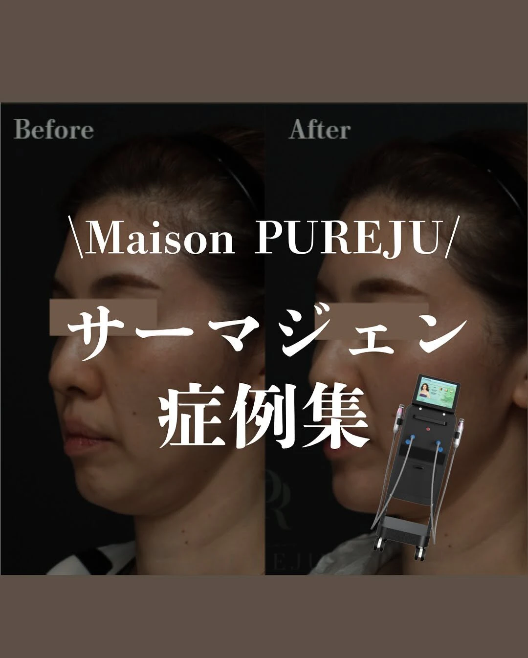 サーマジェン症例|高周波たるみ治療の2段階効果と当院こだわりのオーダーメイド照射