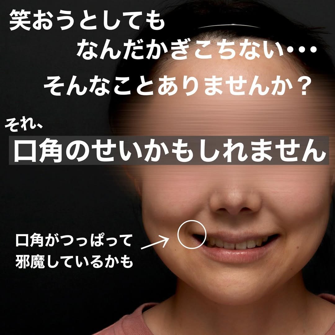 口角挙上で笑顔としゃべりやすさも改善した術後3ヶ月の長期経過症例 画像2
