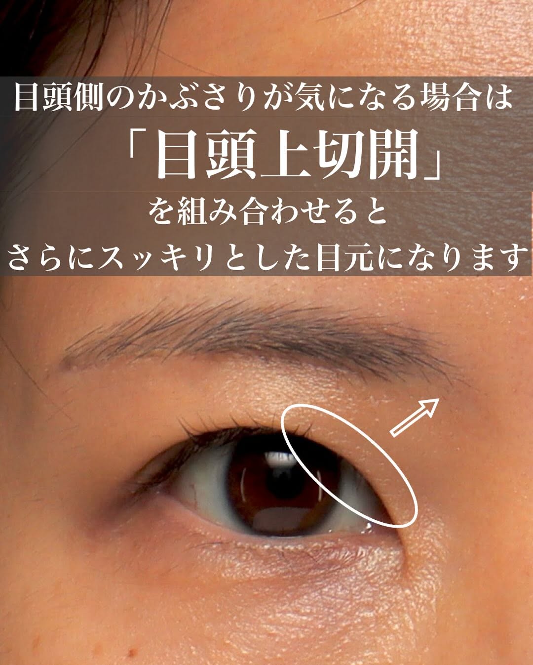 眉下切開でまぶたのたるみを自然に改善し少し昔の自分に戻った症例 画像3