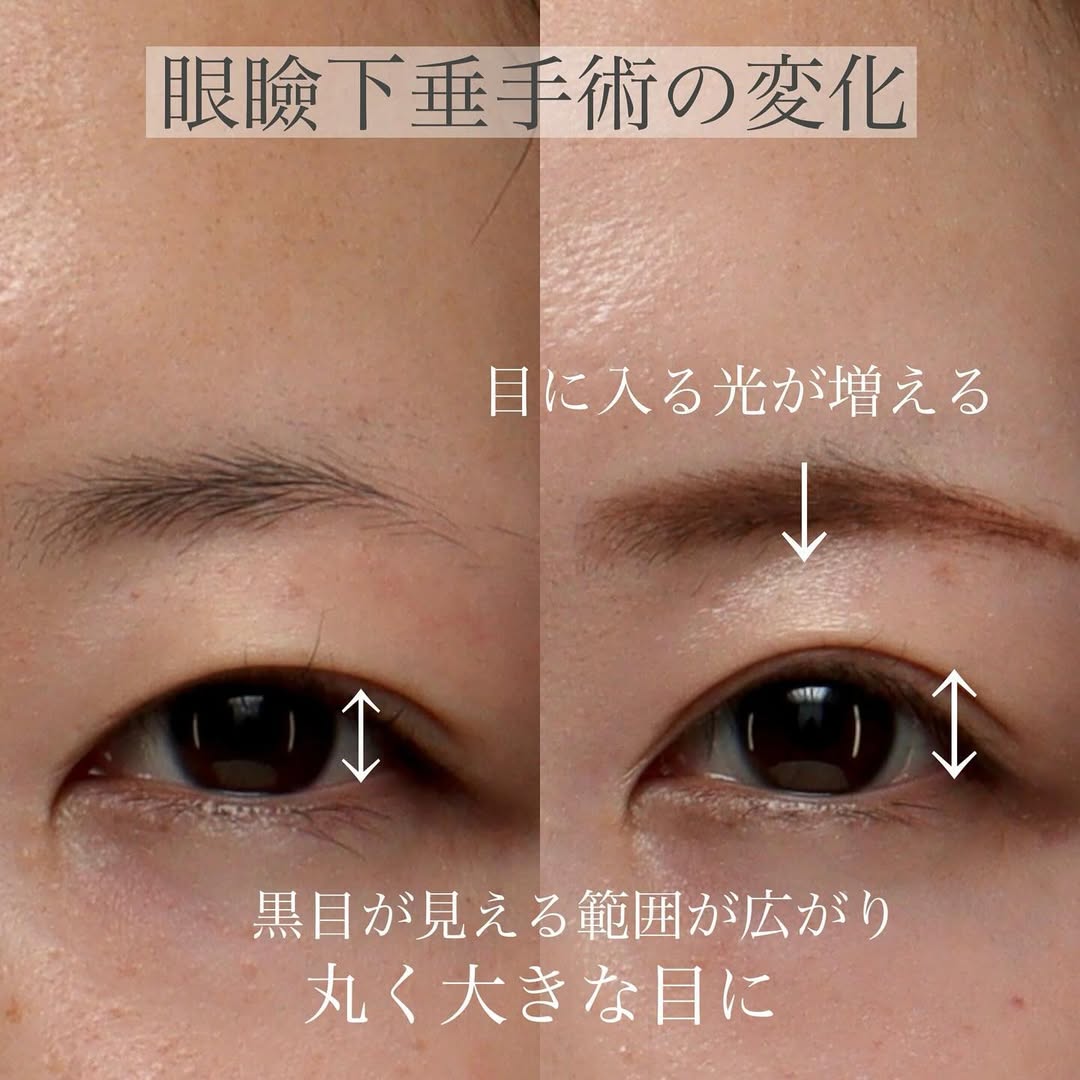 眼瞼下垂手術で黒目全体が見えるようになり目の開きと印象を改善した症例 画像2