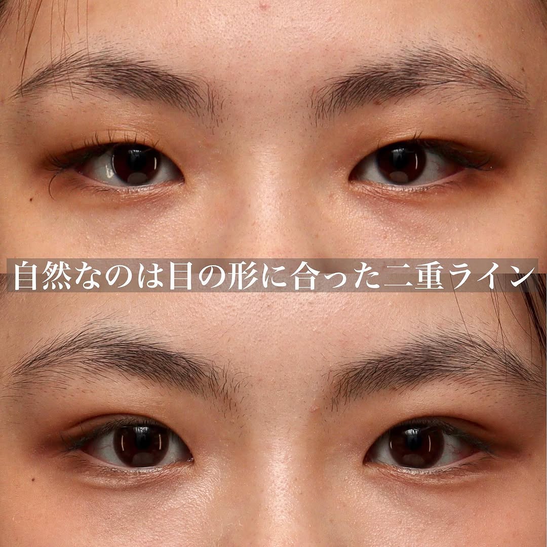骨格に合わせた自然な末広二重埋没で周りにバレない変化を実現した症例