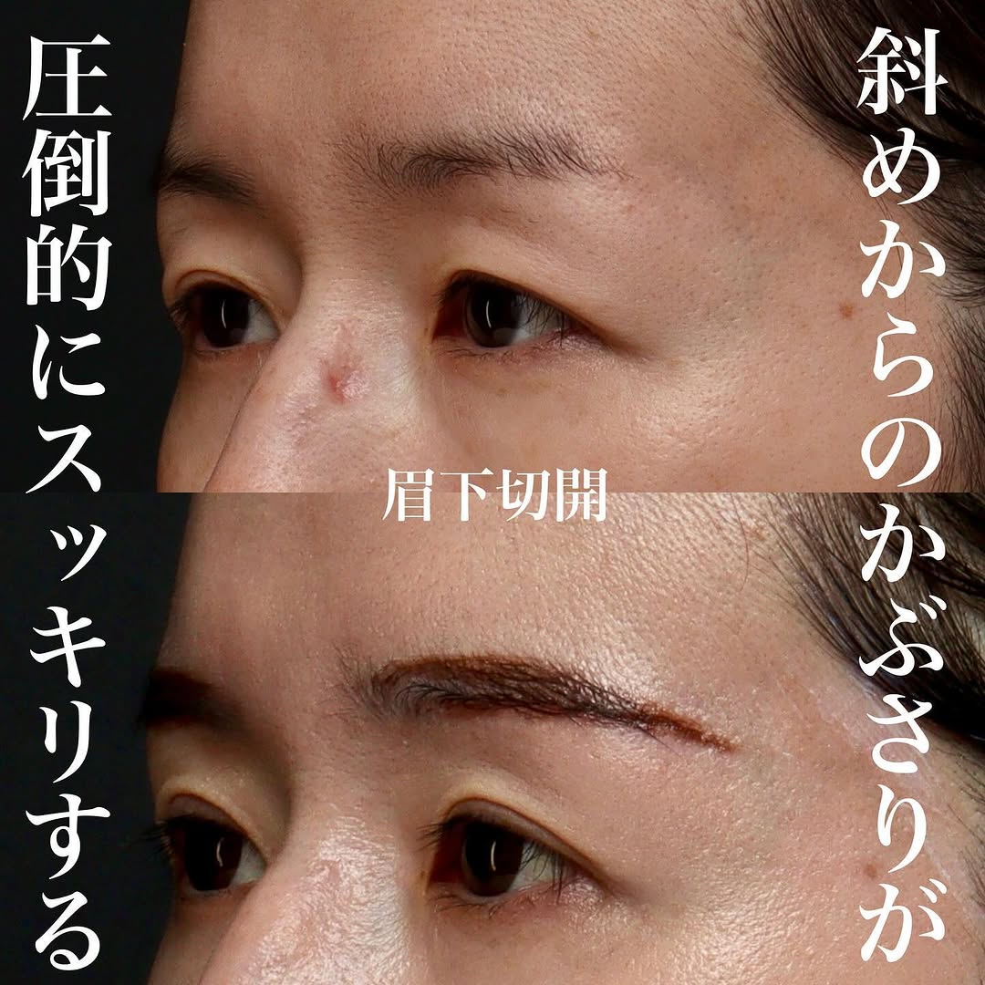 眉下切開で少し昔の自分に戻るアンチエイジング効果を実感した症例 画像2