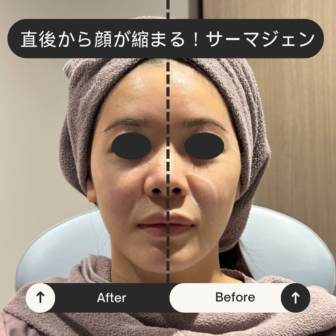 愛してやまないサーマジェン！痛くない・ダウンタイムなし・効果高いの三拍子