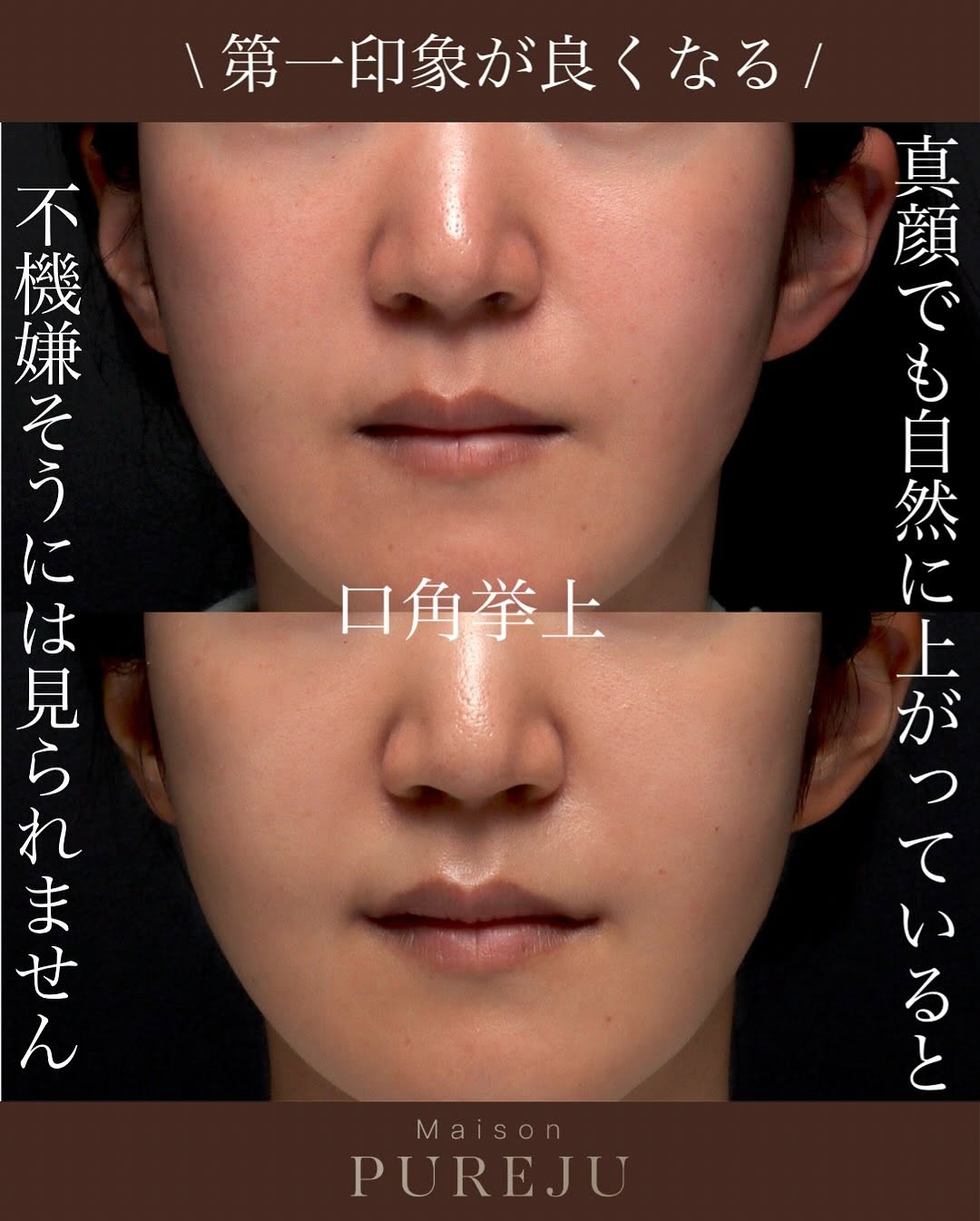 口角挙上で口角のつっぱりを解除し笑顔が変わった症例 画像2