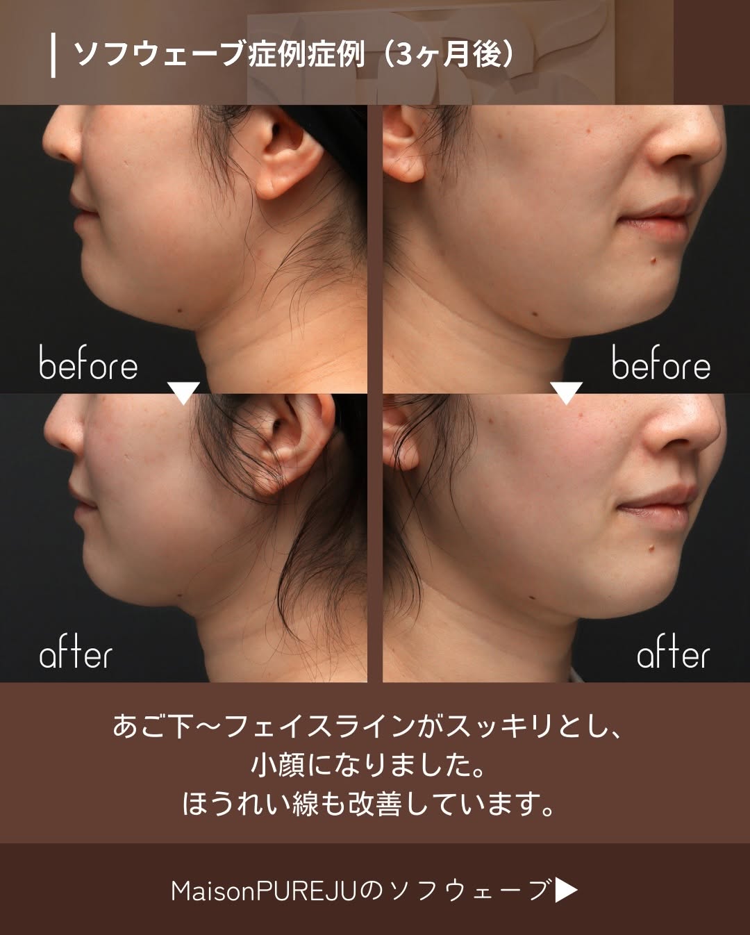 ソフウェーブで30代のフェイスラインのたるみをピタッと引き締めた症例 画像2