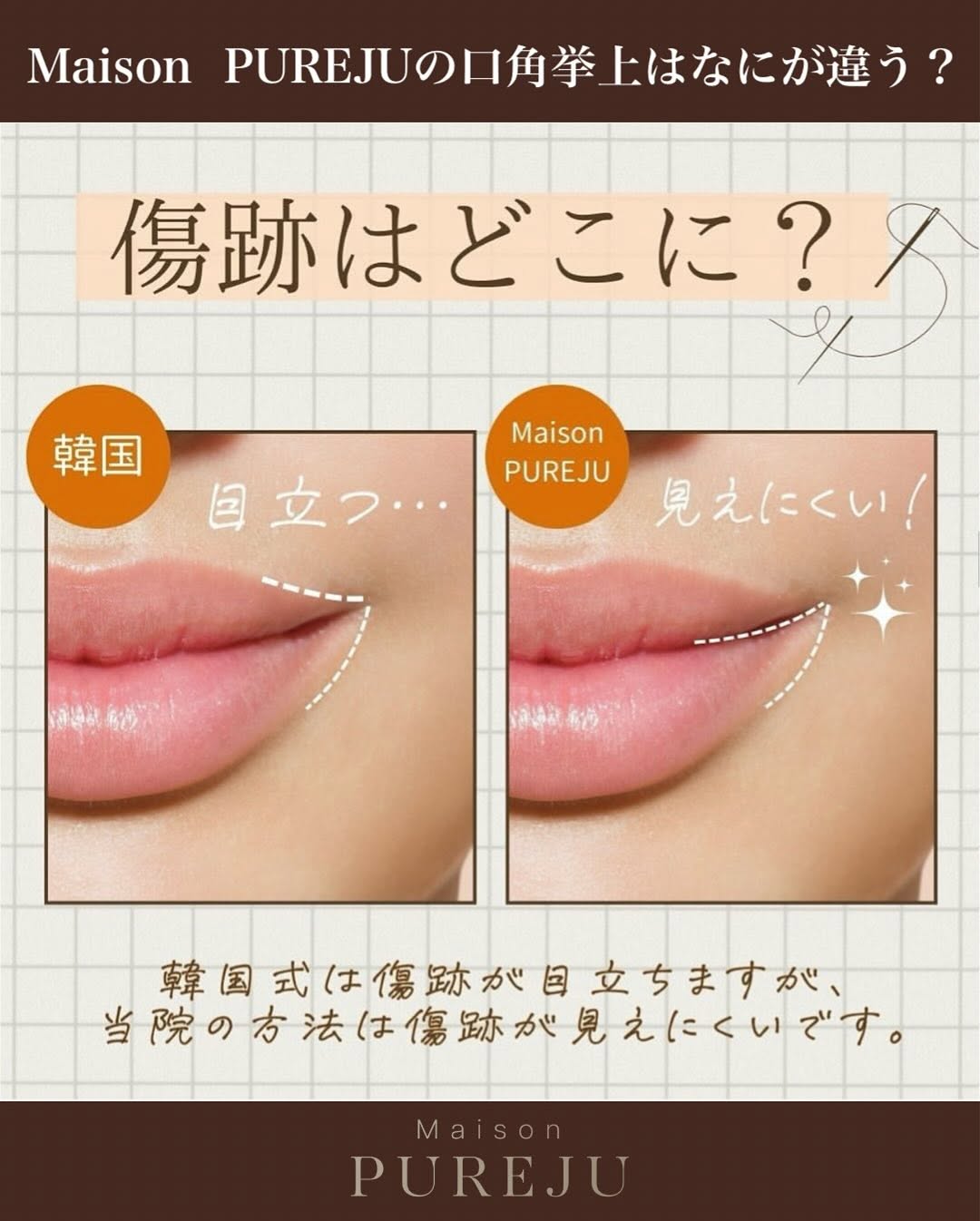 口角挙上＋ショートスレッドで印象アップと輪郭の引き締めを同時に実現した症例 画像3