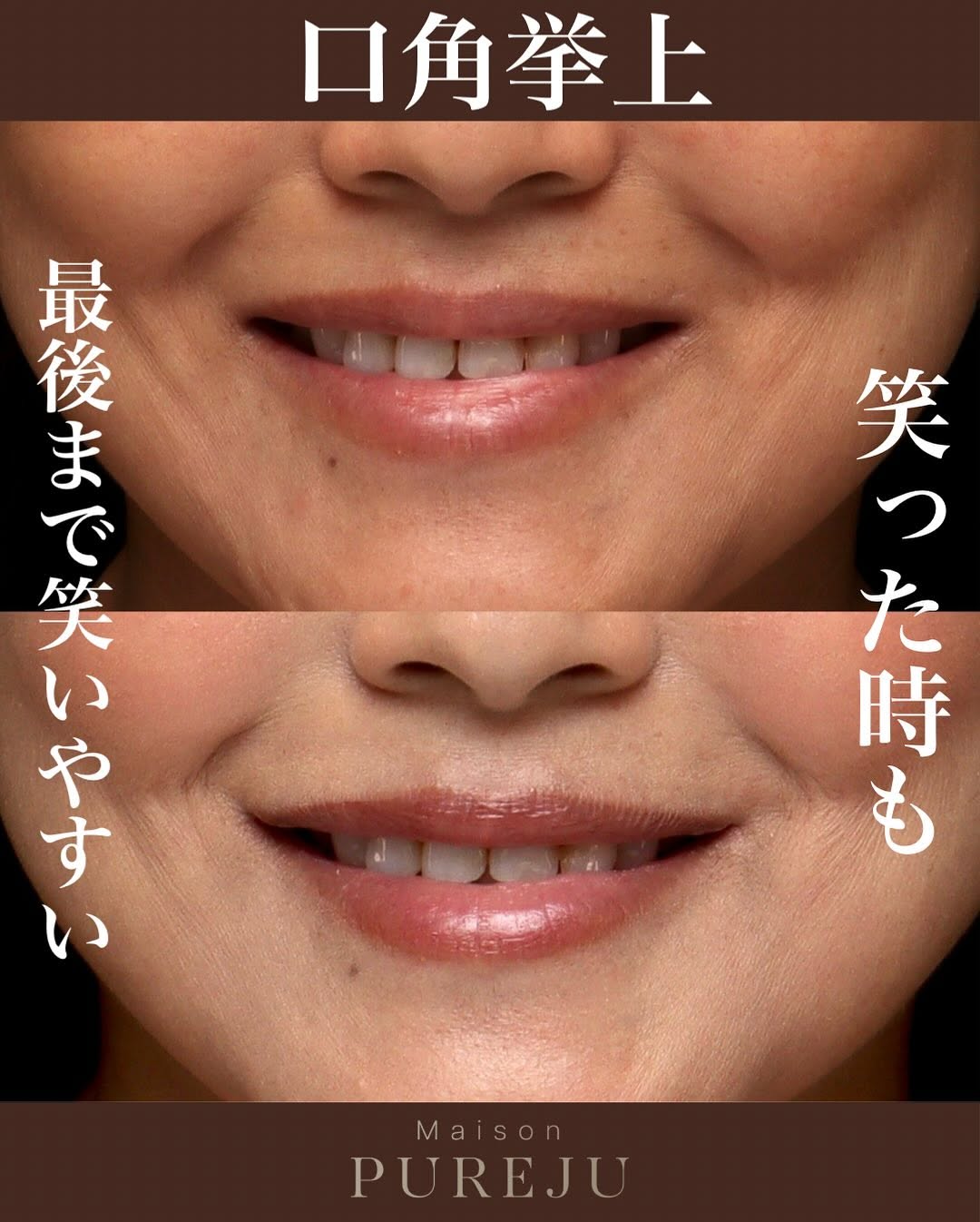 口角挙上で不機嫌そうに思われる悩みを解決した症例 画像2
