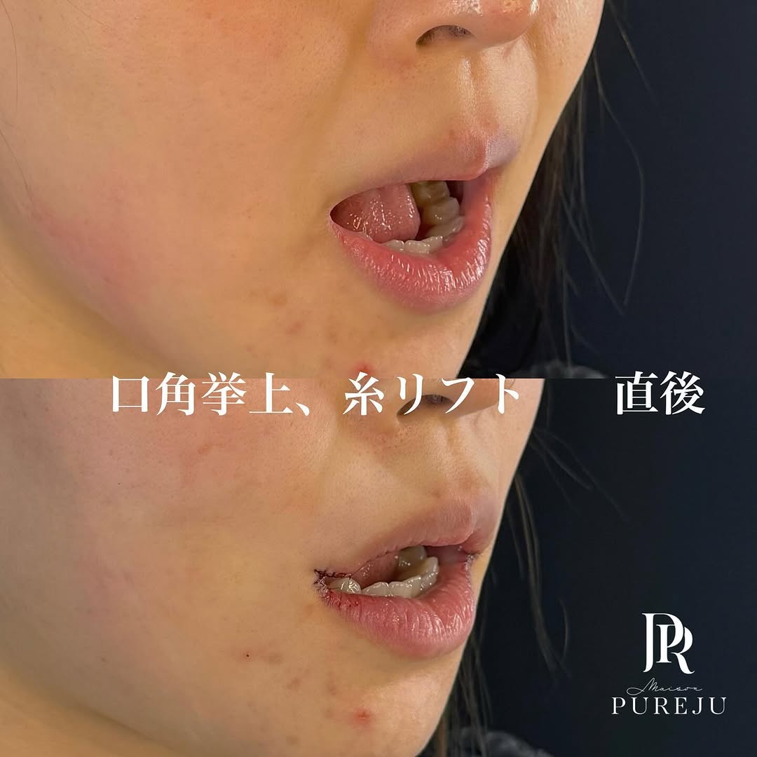 口角挙上＋糸リフトの直後ダウンタイム経過を示した症例 画像4