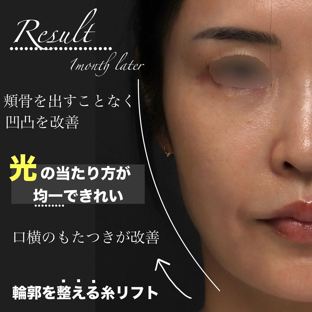 糸リフトの適材適所な使い分けでフェイスラインを自然に整えた症例 画像3
