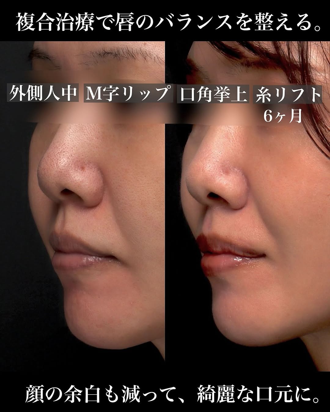 口角挙上＋外側人中＋人中短縮の複合治療で唇と口元全体のバランスを整えた症例