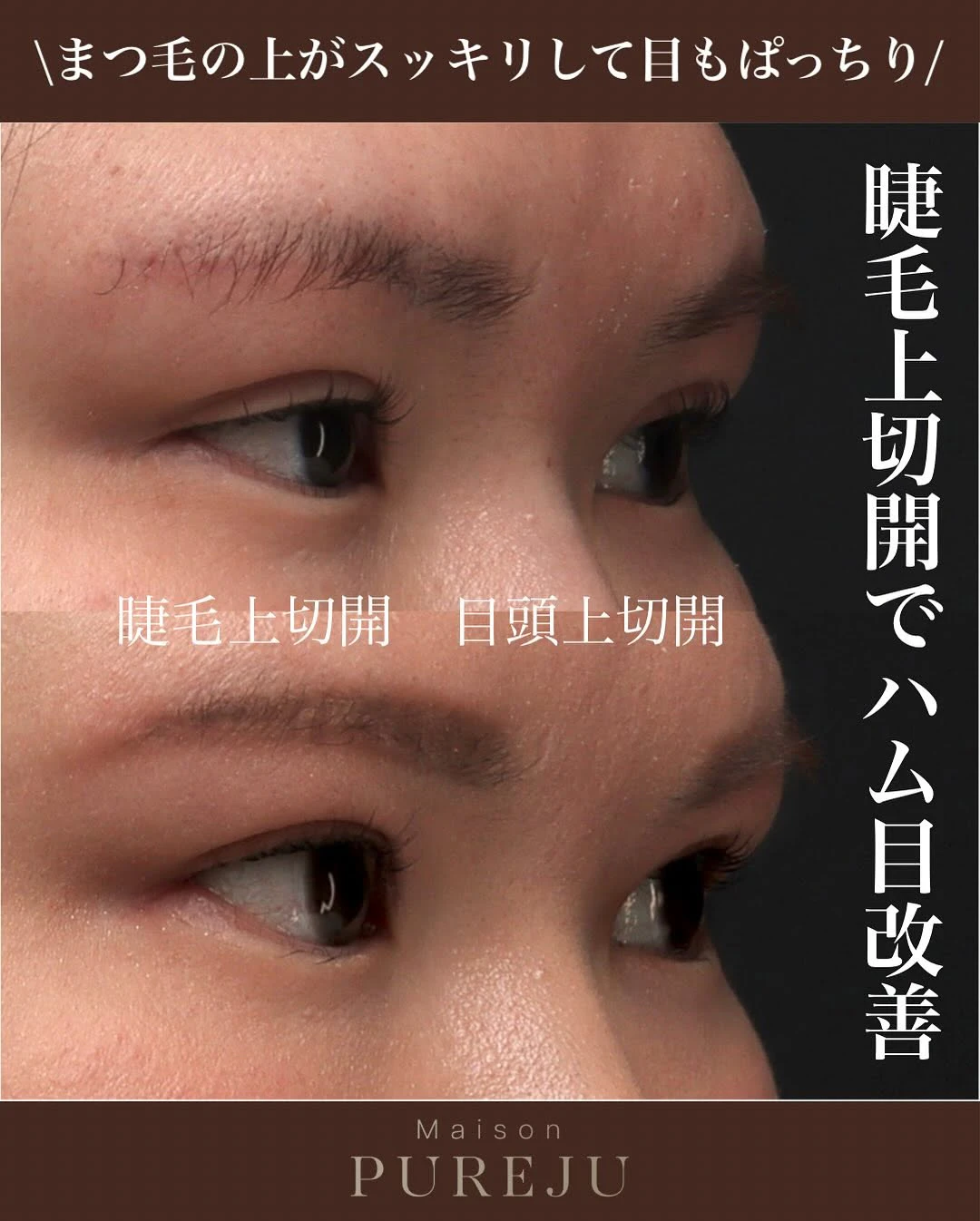 睫毛上切開でまつ毛と二重ラインの間のもたつきを改善しすっきりした目元にした症例