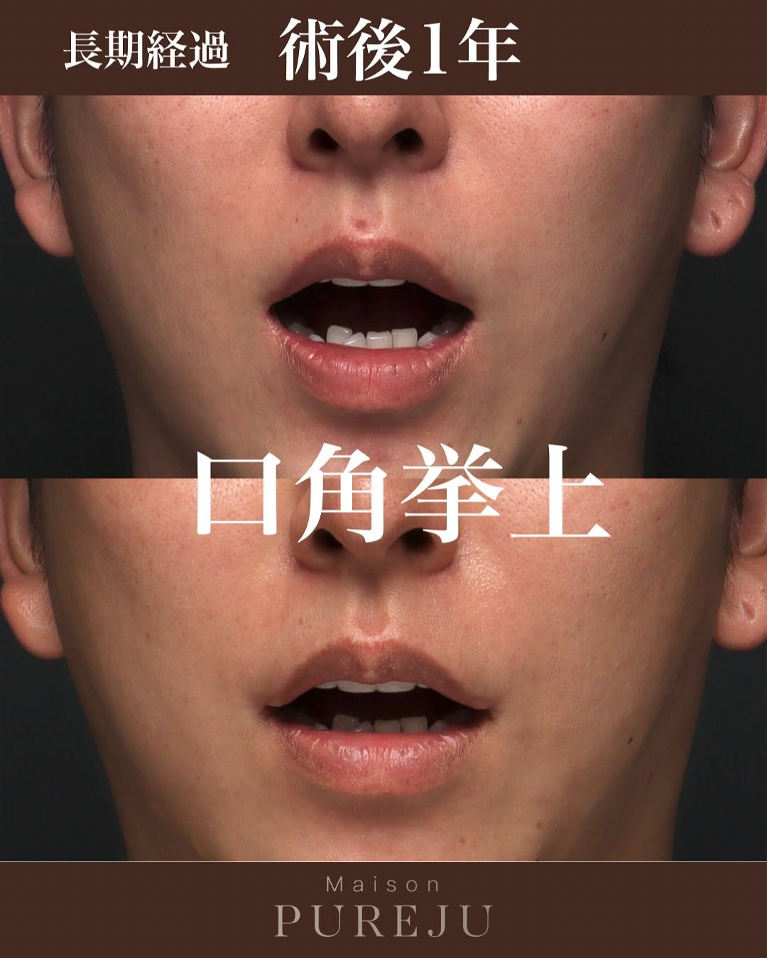 口角挙上術後1年の長期経過で笑いやすさ・しゃべりやすさも維持している症例 画像2