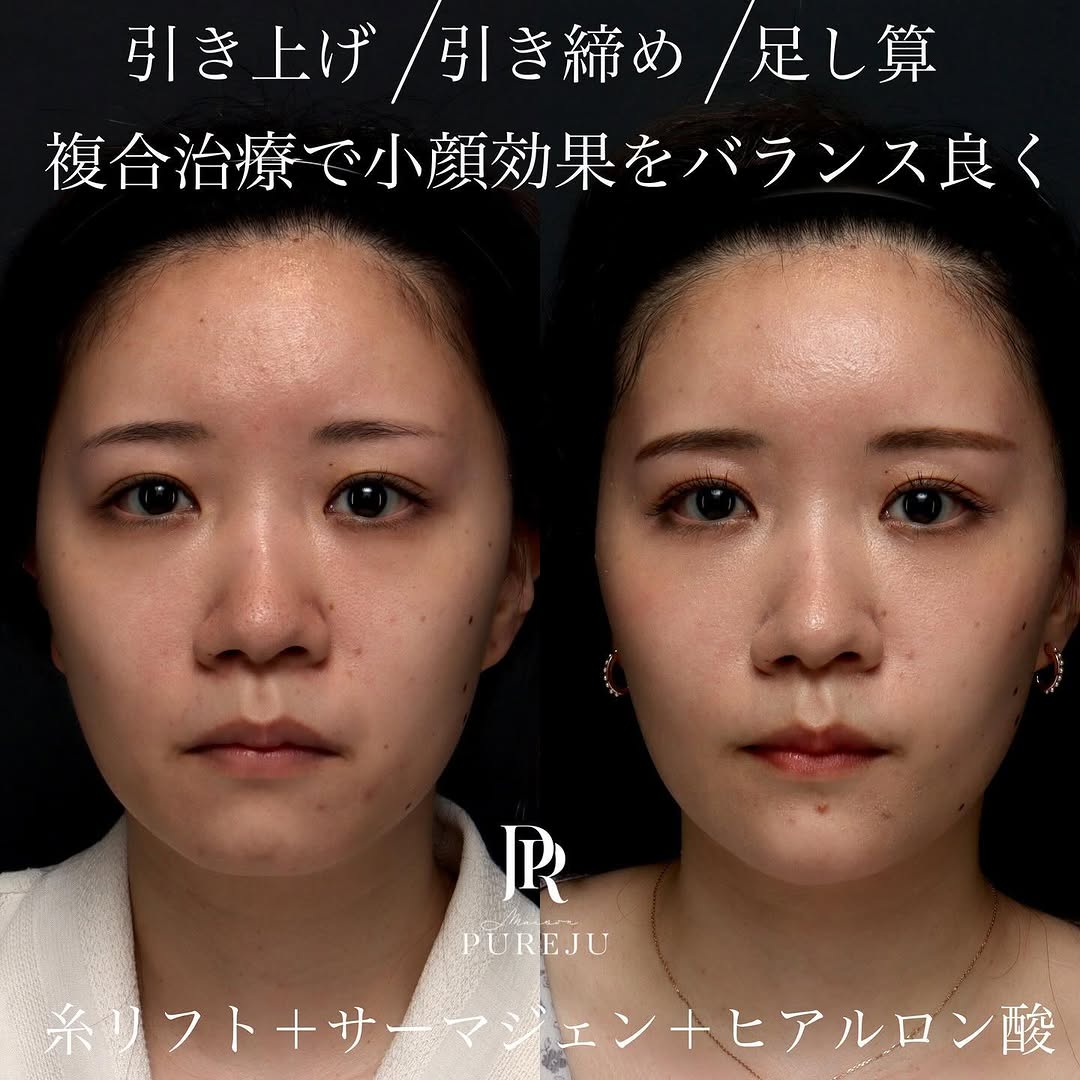 糸リフト＋サーマジェン＋ヒアルロン酸＋ボトックスのコンビネーションでバランス良く小顔に整えた症例 画像2