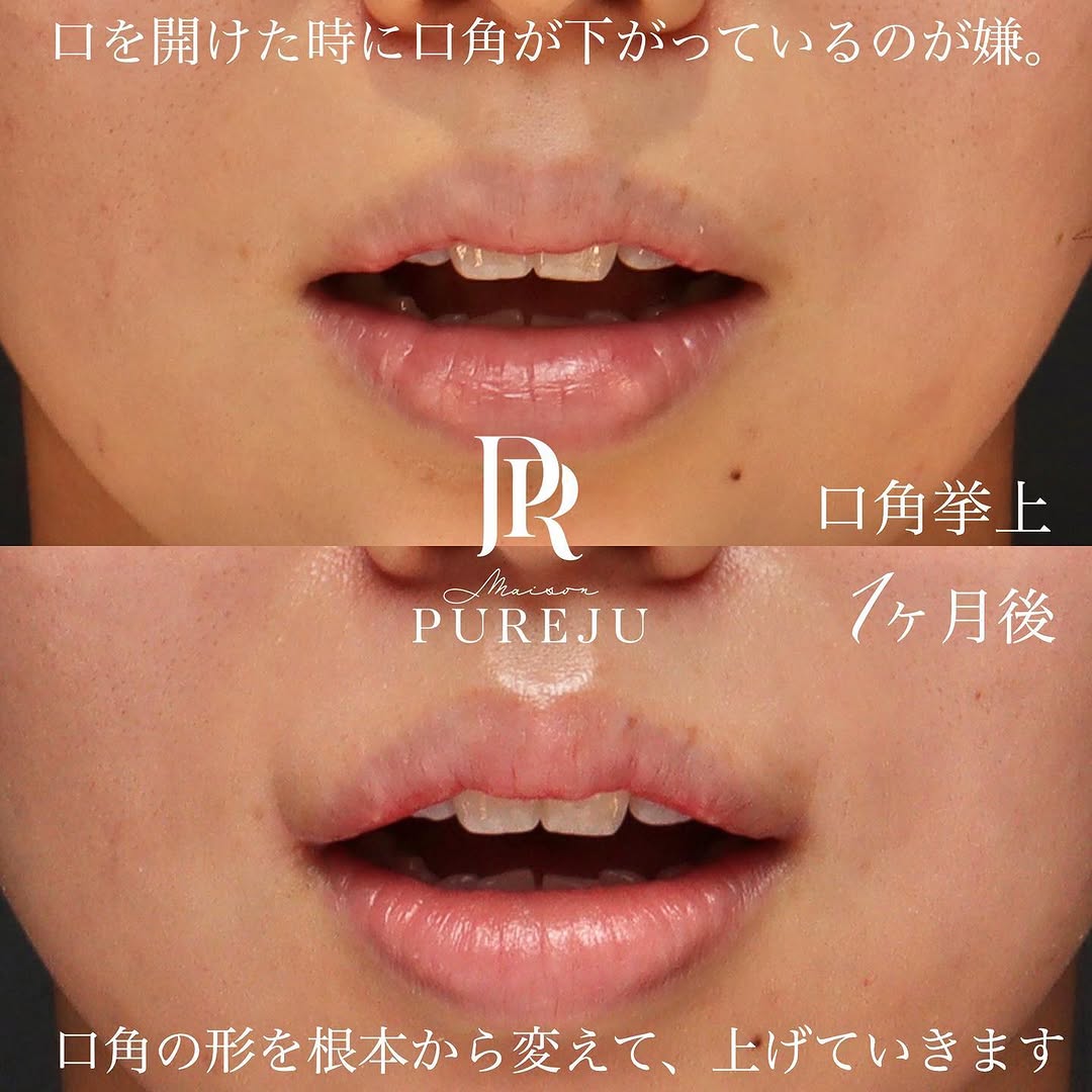 口角挙上でナチュラルに口角を上げ「不機嫌そう」な印象を改善した症例（術後1ヶ月） 画像3