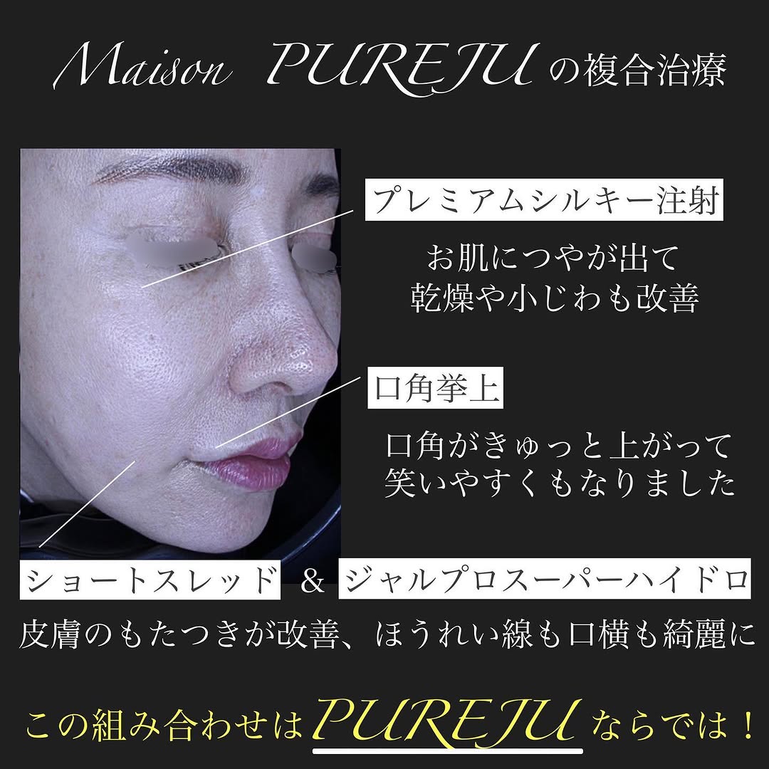 ジャルプロ＋ショートスレッド＋シルキー注射＋口角挙上の複合治療で口横のたるみを整えた症例 画像4