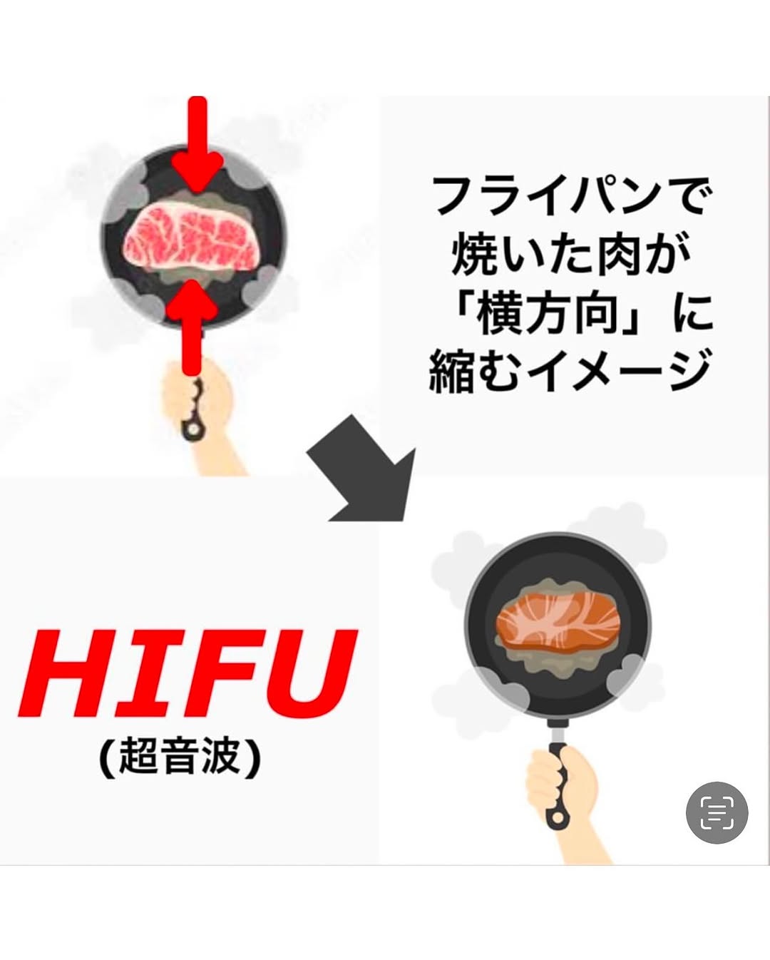ウルトラセルZi（HIFU）＋ザーフ（RF）の組み合わせでたるみを全層引き締めた症例 画像3