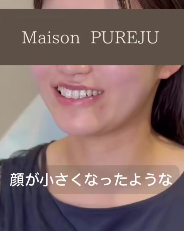 口角挙上＋ヒアルロン酸で笑顔が良くなり唇のバランスも整えた症例 画像2