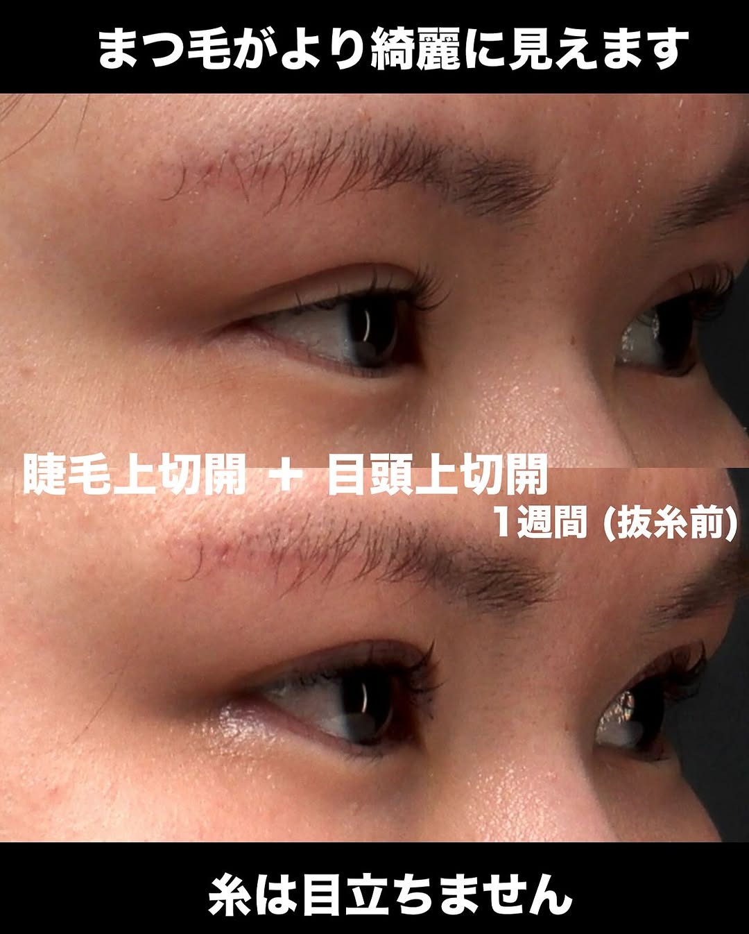 睫毛上切開＋目頭上切開でハム目を修正し綺麗な目元に整えた症例（術後1週間） 画像2