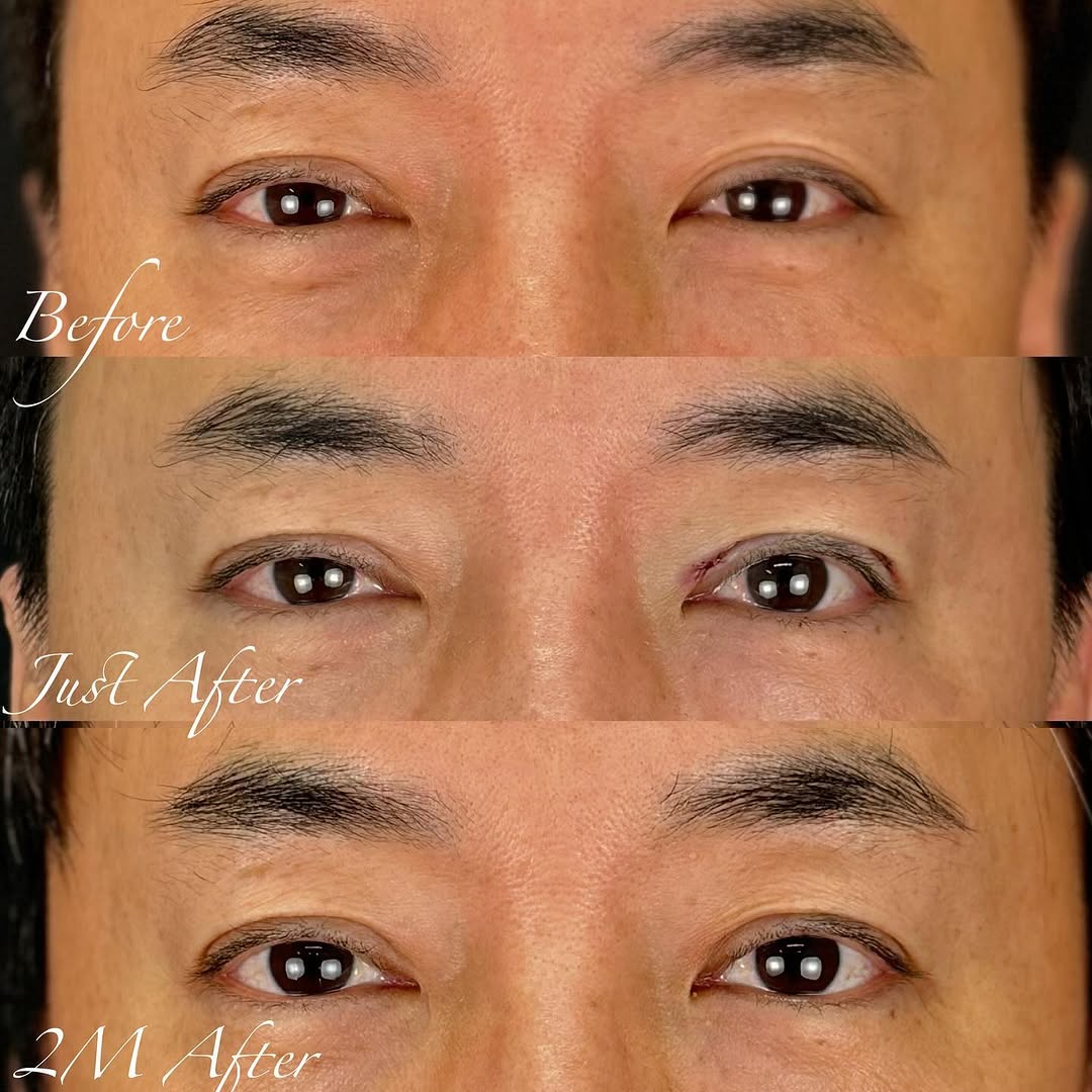 二重全切開で二重ラインの左右差と余分なラインを改善した症例（術後2ヶ月） 画像4