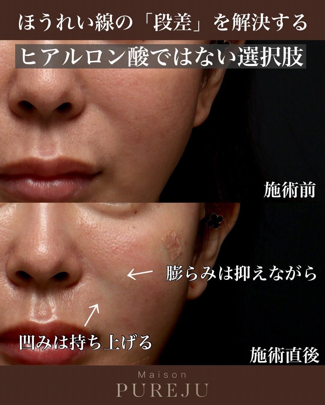 マルチフィル＋フラットリフト＋糸リフトでほうれい線の段差を平らにした症例 画像2