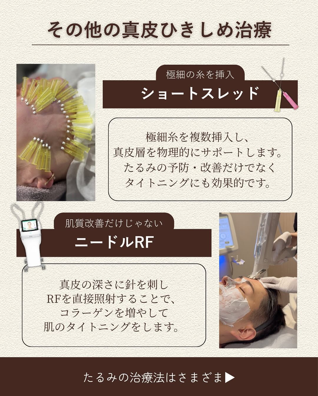 皮膚たるみに特化した治療3選｜ソフウェーブ・ショートスレッド・ニードルRFで真皮層から引き締め 画像4