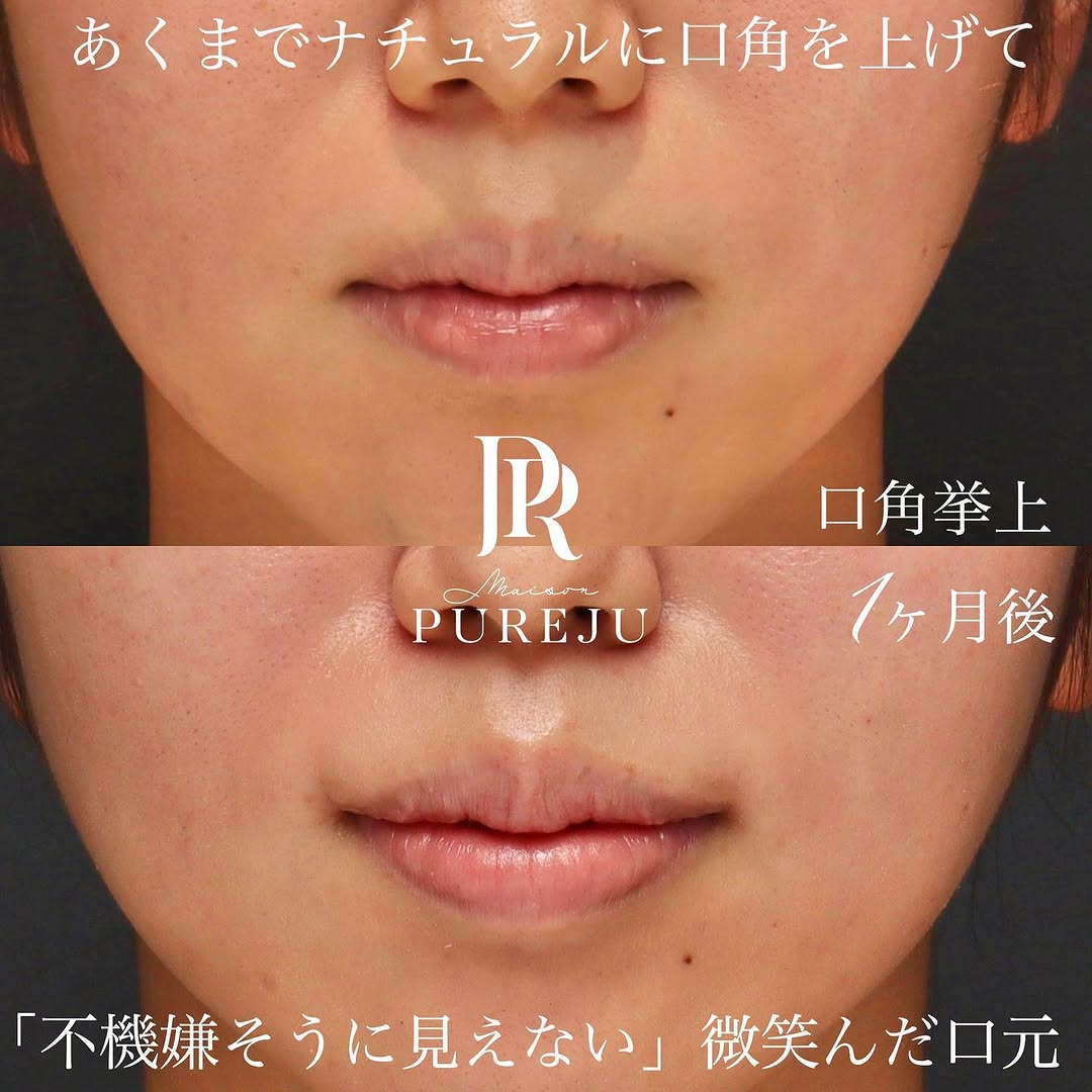 口角挙上でナチュラルに口角を上げ「不機嫌そう」な印象を改善した症例（術後1ヶ月）