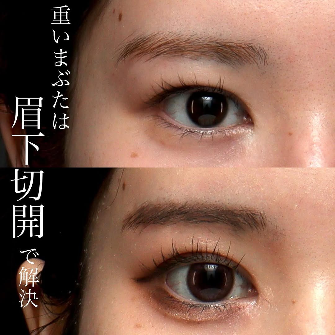 眉下切開でまぶたのもたつきをすっきり改善した症例（術後6ヶ月）