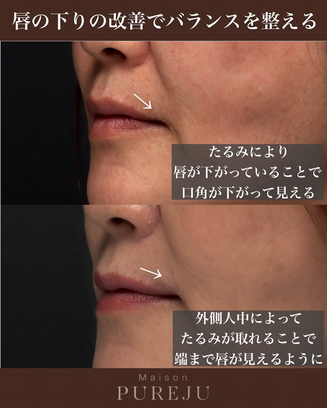 外側人中短縮で唇の外側を持ち上げお顔の余白を改善した術後1ヶ月の症例 画像3