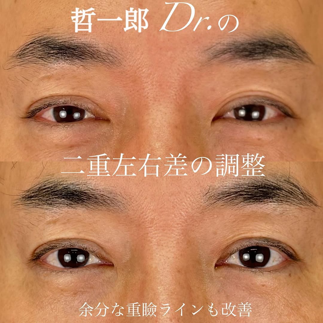 二重全切開で二重ラインの左右差と余分なラインを改善した症例（術後2ヶ月）