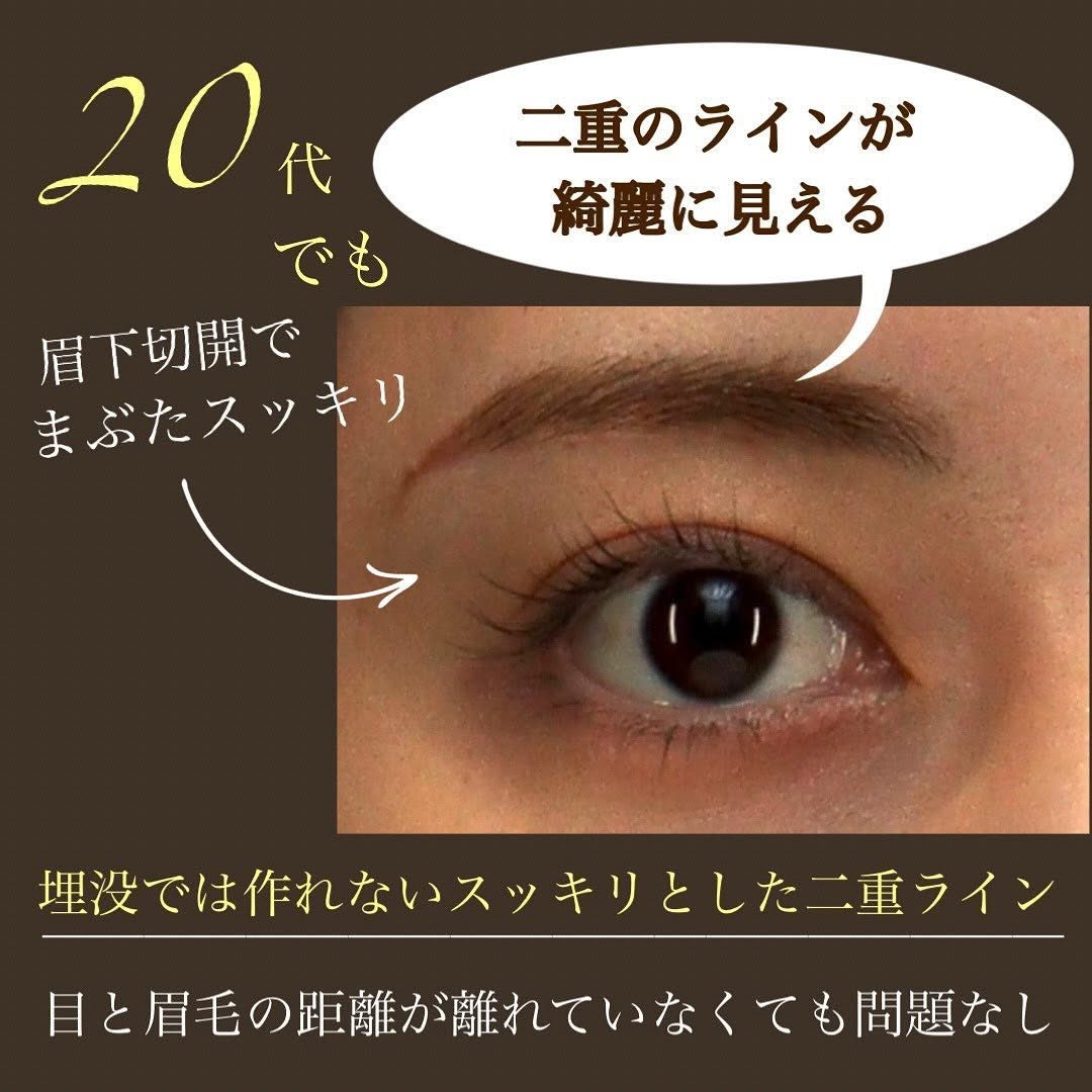 20代の眉下切開でまぶたの被さりを改善し本来の二重ラインを取り戻した症例 画像4