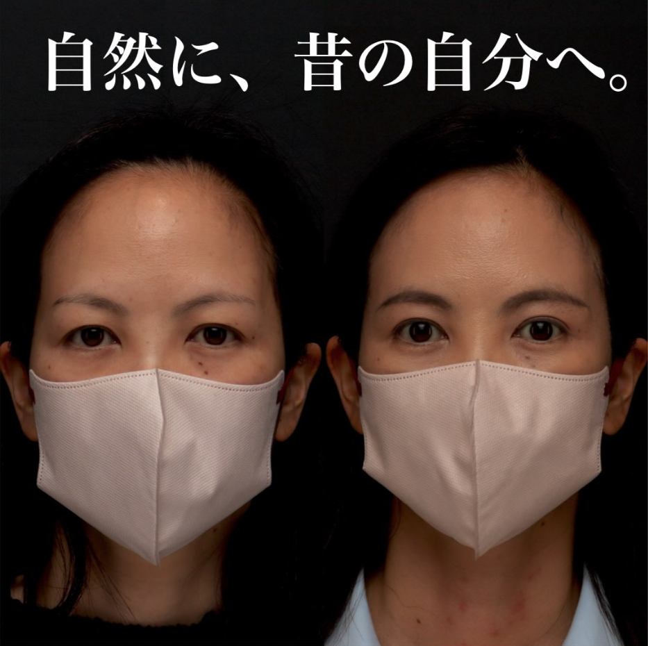 眉下切開で目尻側のたるみを取り自然に目元を若返らせた症例（術後6ヶ月・メイクなし） 画像3