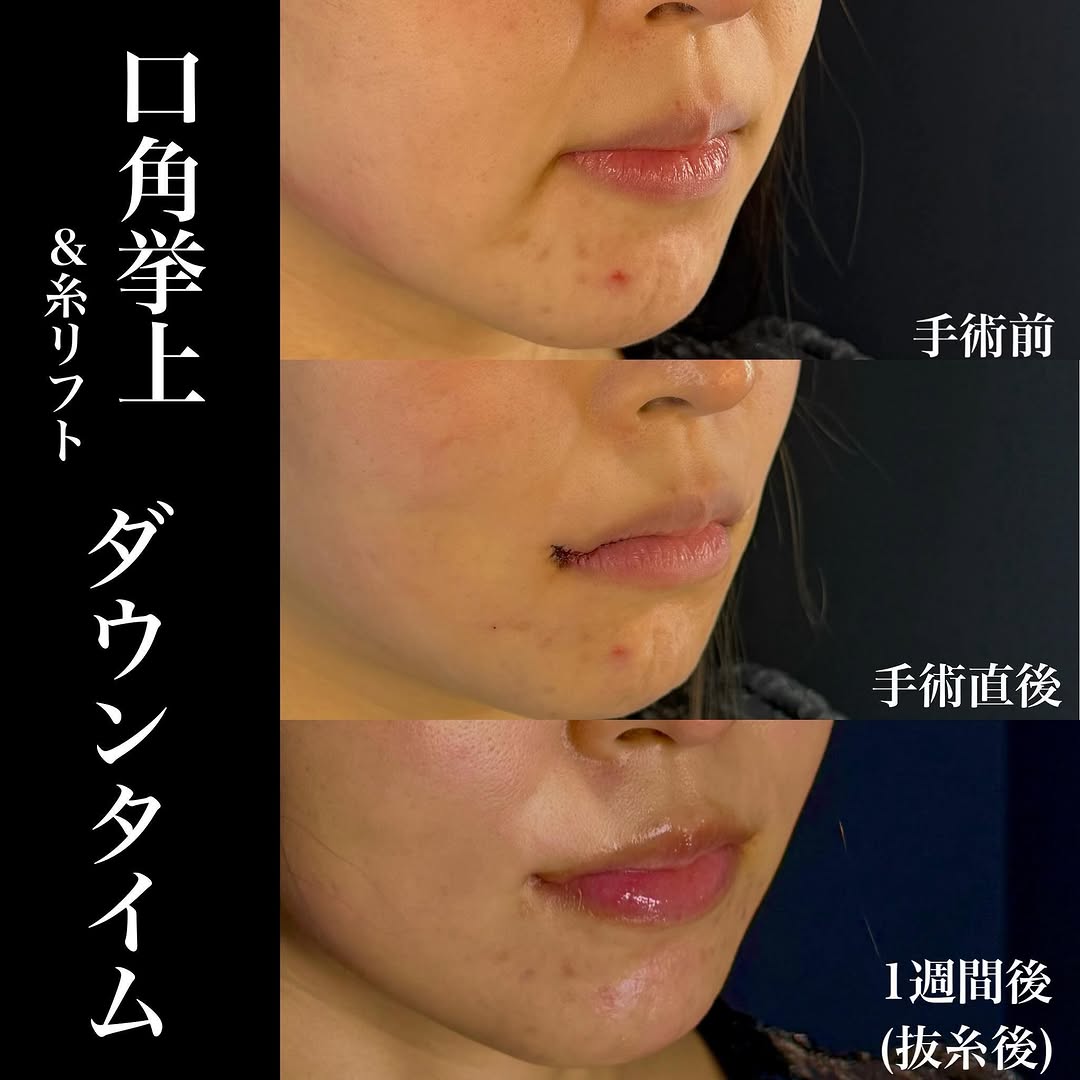 口角挙上＋糸リフト術後1週間のダウンタイム経過を示した症例