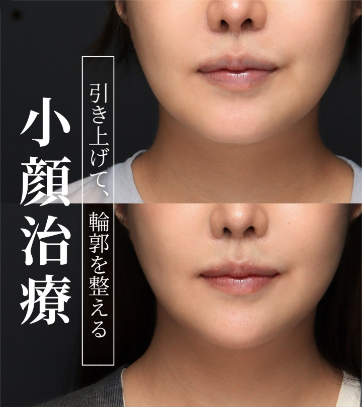 糸リフトでフェイスラインを引き上げあごのVラインを整えた症例（2ヶ月後）