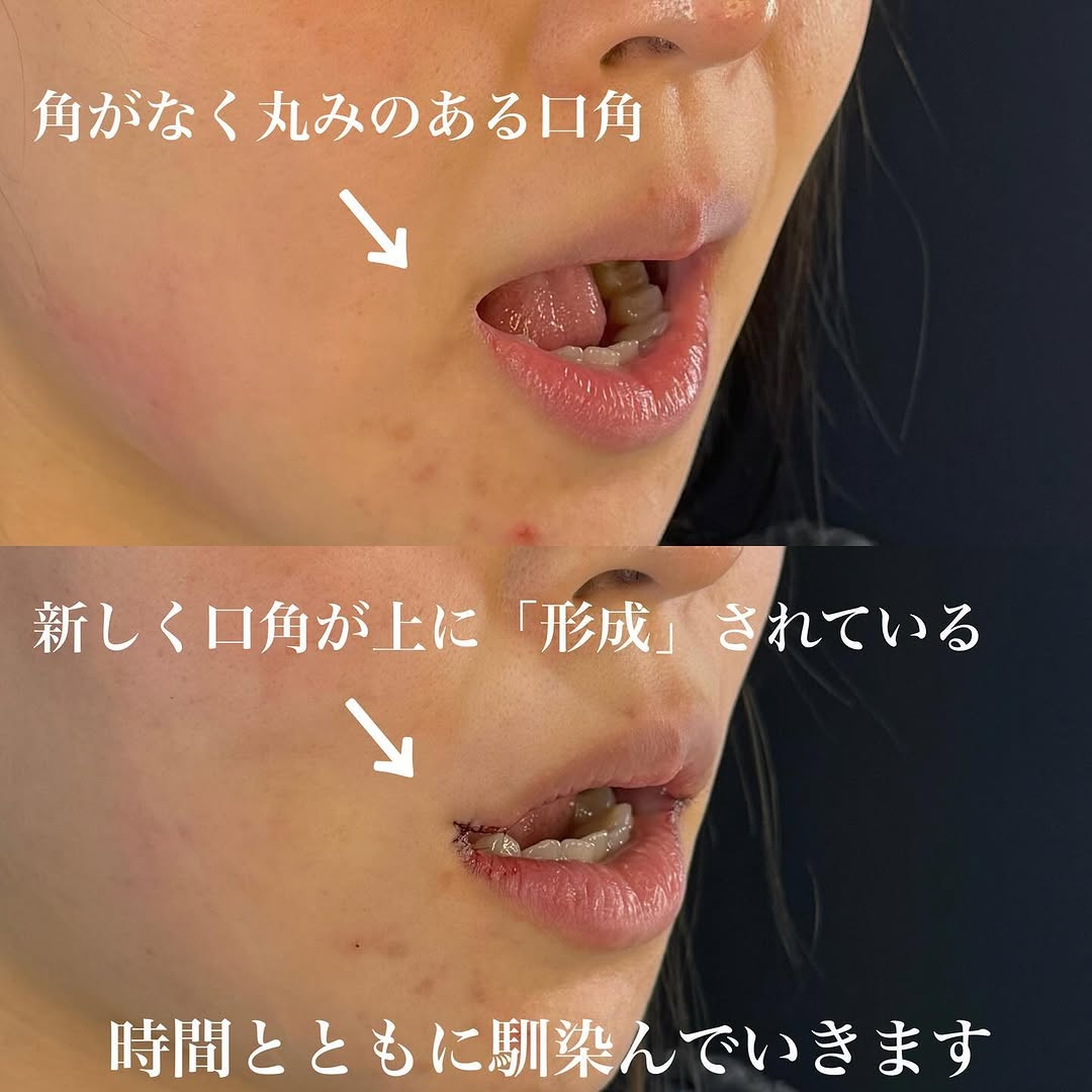 口角挙上＋糸リフトの直後ダウンタイム経過を示した症例 画像5