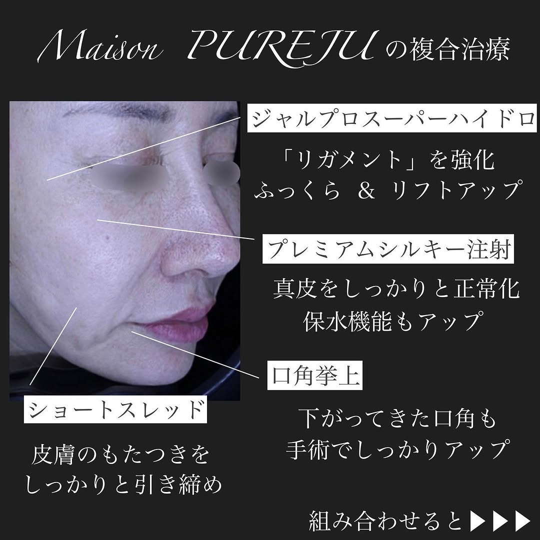 ジャルプロ＋ショートスレッド＋シルキー注射＋口角挙上の複合治療で口横のたるみを整えた症例 画像3