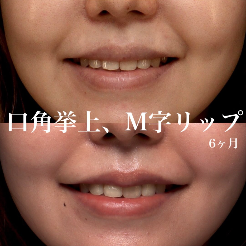 口角挙上＋M字リップで笑顔のぎこちなさを改善し丸みのある口元に整えた症例（術後6ヶ月）