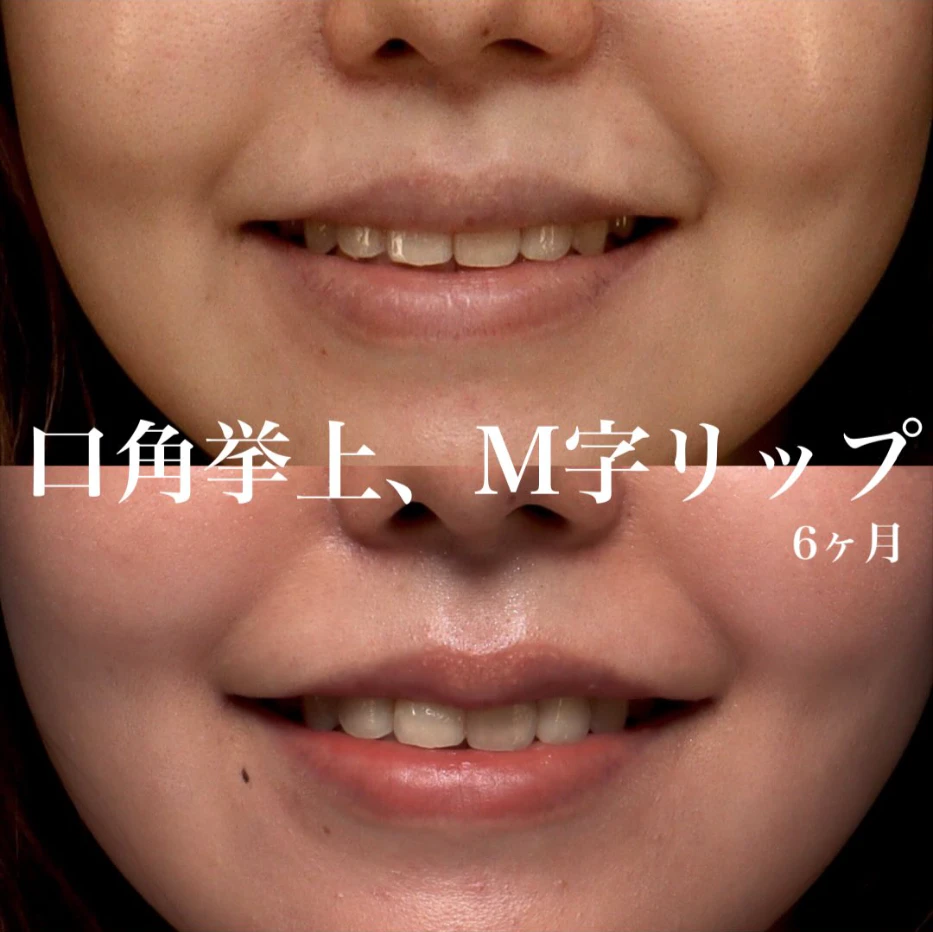 口角挙上+M字リップで笑顔のぎこちなさを改善し丸みのある口元に整えた症例(術後6ヶ月)